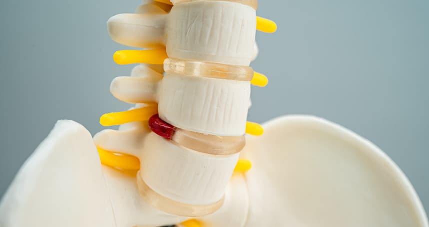 maqueta de columna vertebral mostrando la hernia discal